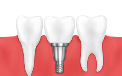 Consejos para el mantenimiento de implantes dentales